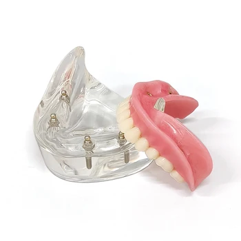 Стоматологичен беззъба подвижна протеза с формирането на устната кухина, 4 бр, импланти, за да пирони за реставрация