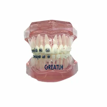 Модел на зъби с метални и керамични брекетами, модел за изучаване на ортодонтско лечение, модел за обучение по стоматология